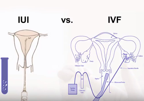 IUI-or-IVF-Failures