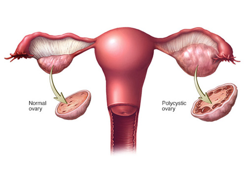 PCOS-PCOD-Condition